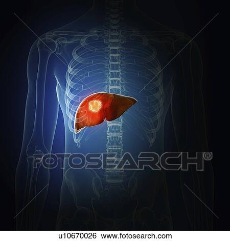Stock Photograph - Illustration of liver cancer. Fotosearch