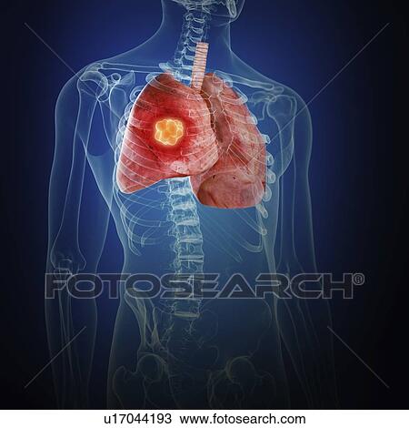 Stock Image - Illustration of lung cancer. Fotosearch