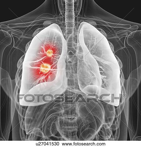 Illustration of lung cancer View Large Photo Image Stock Image - Illustration of lung cancer. Fotosearch