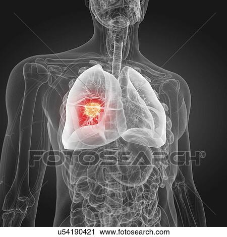 Stock Image - Illustration of lung cancer. Fotosearch