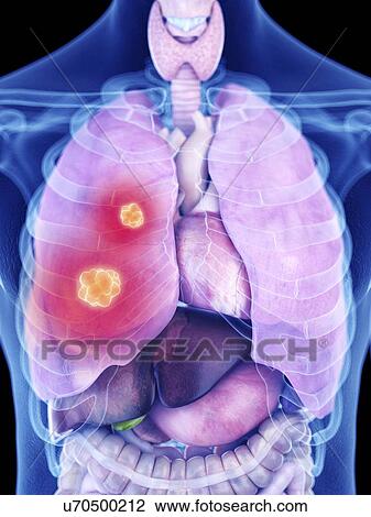 Illustration of lung cancer View Large Photo Image Stock Image - Illustration of lung cancer. Fotosearch