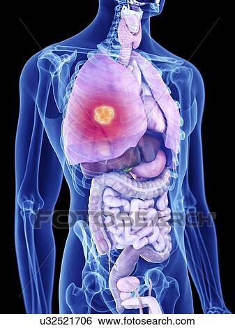 Illustration of lung cancer View Large Photo Image Stock Photograph - Illustration of lung cancer. Fotosearch