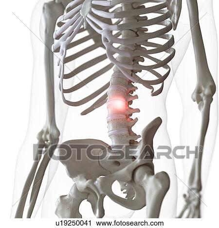 Stock Image - Illustration of pain in the lower spine. Fotosearch
