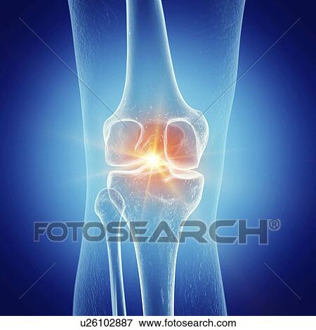 Illustration of painful knee View Large Photo Image Stock Photo - Illustration of painful knee. Fotosearch