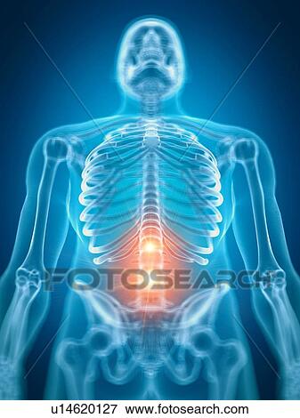 Stock Photo - Illustration of painful lower spine. Fotosearch