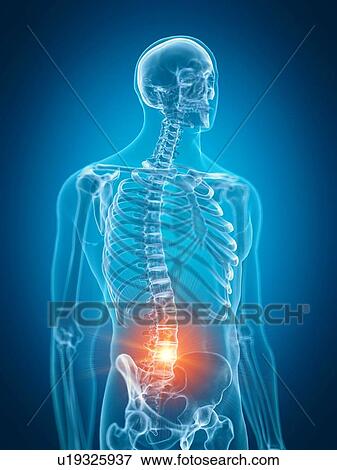 Stock Photo - Illustration of painful lower spine. Fotosearch