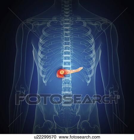 Stock Image - Illustration of pancreas cancer. Fotosearch