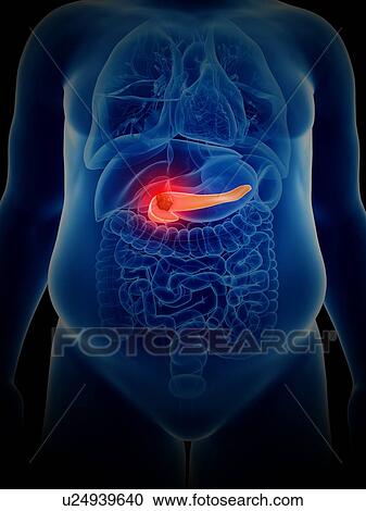 Stock Image - Illustration of pancreas cancer. Fotosearch