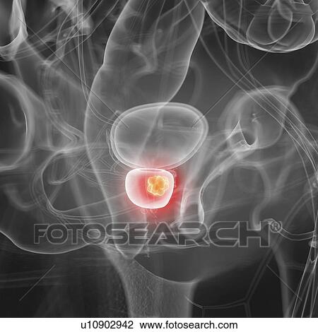 Illustration of prostate cancer View Large Photo Image Stock Image - Illustration of prostate cancer. Fotosearch