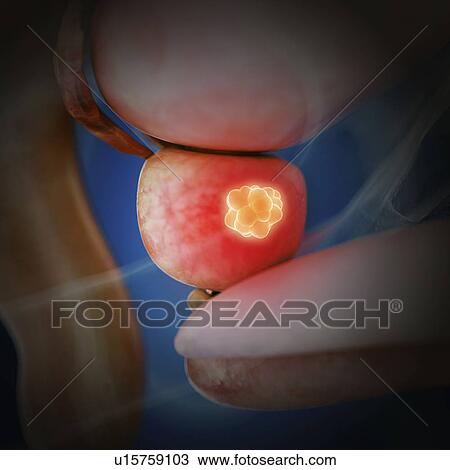 Stock Image - Illustration of prostate cancer. Fotosearch