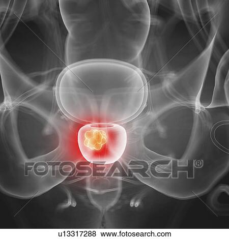 Illustration of prostate cancer View Large Photo Image Stock Photo - Illustration of prostate cancer. Fotosearch