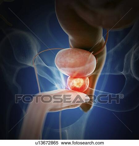 Illustration of prostate cancer View Large Photo Image Stock Photography - Illustration of prostate cancer. Fotosearch