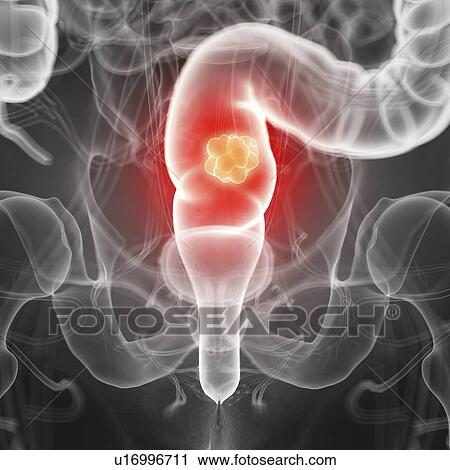 Stock Image - Illustration of rectal cancer. Fotosearch