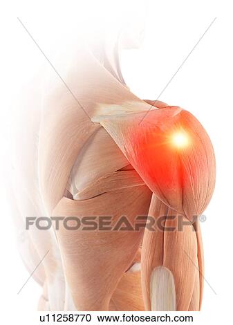 Illustration of shoulder muscle pain View Large Photo Image Stock Image - Illustration of shoulder muscle pain. Fotosearch