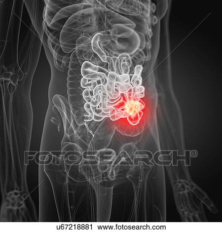 Stock Image - Illustration of small intestine cancer. Fotosearch