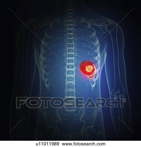 Stock Photo - Illustration of spleen cancer. Fotosearch