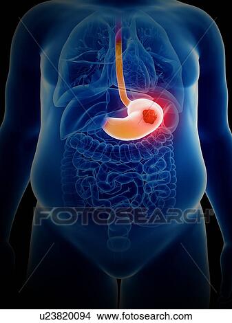 Picture - Illustration of stomach cancer. Fotosearch