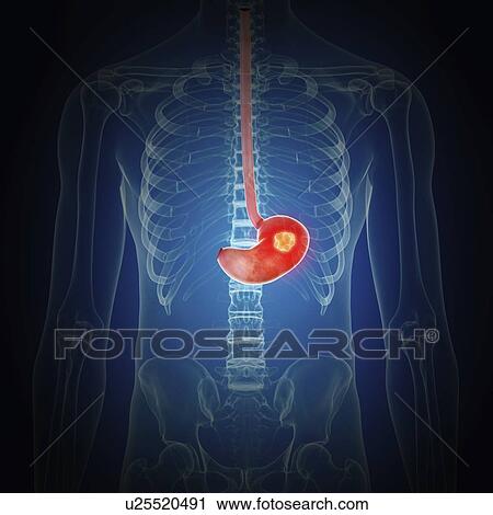 Illustration of stomach cancer View Large Photo Image Stock Image - Illustration of stomach cancer. Fotosearch