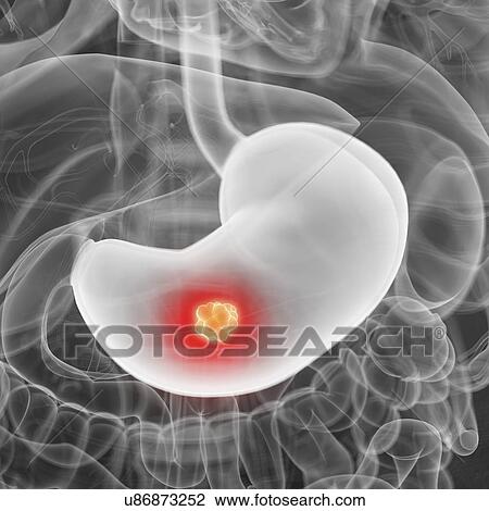 Illustration of stomach cancer View Large Photo Image Stock Image - Illustration of stomach cancer. Fotosearch
