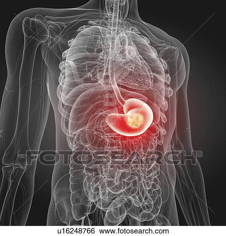 Illustration of stomach cancer View Large Photo Image Stock Photograph - Illustration of stomach cancer. Fotosearch
