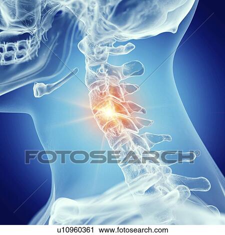 Stock Image - Illustration of the cervical spine. Fotosearch