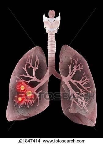 Picture - Illustration of the human lungs and bronchi. Fotosearch