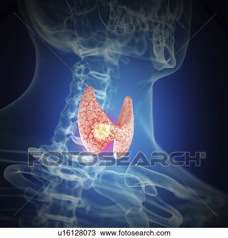 Stock Image - Illustration of thyroid cancer. Fotosearch