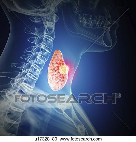 Illustration of thyroid cancer View Large Photo Image Stock Image - Illustration of thyroid cancer. Fotosearch