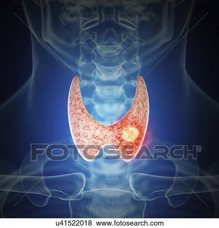 Stock Photo - Illustration of thyroid cancer. Fotosearch