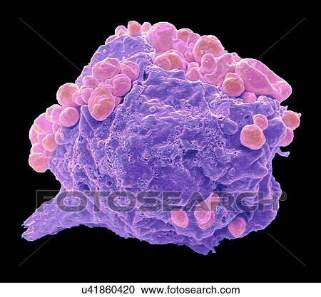 Stock Image - Lymphoma cancer cell, SEM. Fotosearch