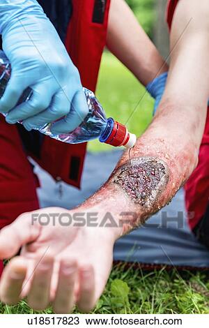 Medical worker treating burns on man's arm View Large Photo Image Stock Image - Medical worker treating burns on man's arm. Fotosearch