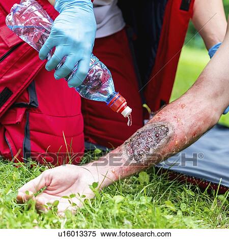 Stock Photography - Medical worker treating burns on man's arm. Fotosearch