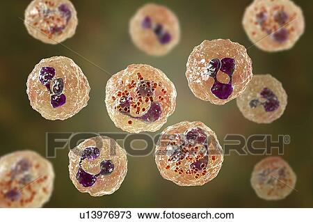 Stock Image - Meningococcal meningitis, illustration. Fotosearch