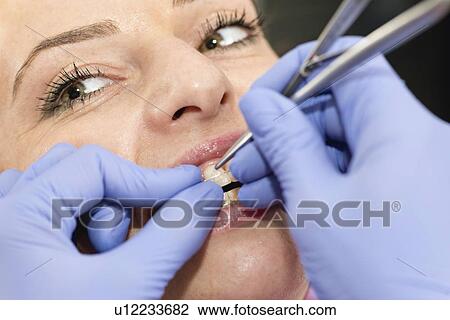 Stock Image - Orthodontist tightening braces. Fotosearch