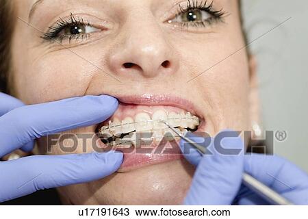 Orthodontist tightening braces View Large Photo Image Stock Image - Orthodontist tightening braces. Fotosearch