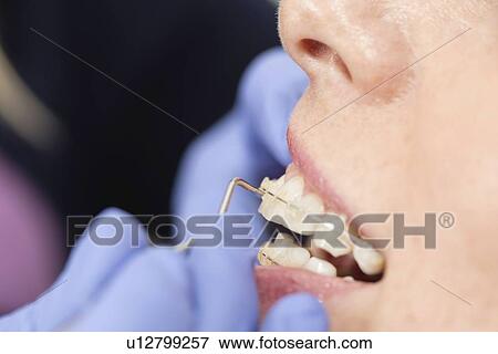 Stock Photo - Orthodontist tightening braces. Fotosearch