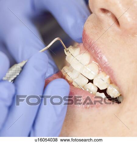 Stock Photo - Orthodontist tightening braces. Fotosearch