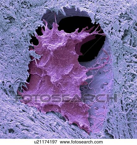 Stock Photo - Osteocyte bone cell. Coloured scanning electron micrograph (SEM) of an osteocyte bone cell (red) surrounded by bone tissue (blue). Osteocytes are osteoblasts (bone-producing cells) that have become trapped within bone cavities (lacunae, depressions in.... Fotosearch