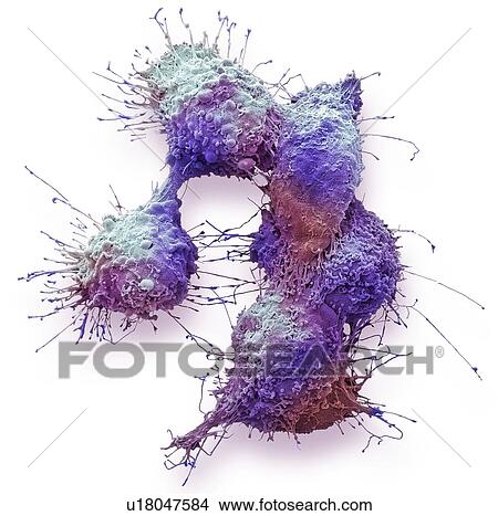 Picture - Ovarian cancer cells. Coloured scanning electron micrograph (SEM) of ovarian cancer cells. Cancer cells are typically large, have an irregular surface and divide rapidly in a chaotic manner. Clumps (tumours) of these cells may form and can invade and.... Fotosearch