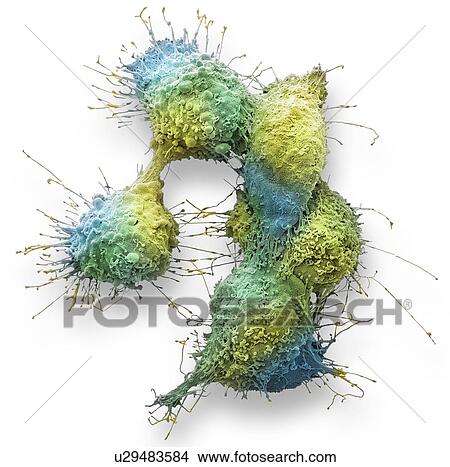 Picture - Ovarian cancer cells. Coloured scanning electron micrograph (SEM) of ovarian cancer cells. Cancer cells are typically large, have an irregular surface and divide rapidly in a chaotic manner. Clumps (tumours) of these cells may form and can invade and.... Fotosearch