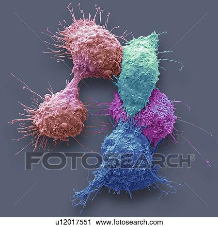 Ovarian cancer cells. Coloured scanning electron micrograph (SEM) of ovarian cancer cells. Cancer cells are typically large, have an irregular surface and divide rapidly in a chaotic manner. Clumps (tumours) of these cells may form and can invade and... View Large Photo Image Stock Image - Ovarian cancer cells. Coloured scanning electron micrograph (SEM) of ovarian cancer cells. Cancer cells are typically large, have an irregular surface and divide rapidly in a chaotic manner. Clumps (tumours) of these cells may form and can invade and.... Fotosearch