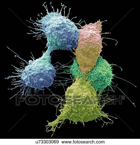 Stock Photo - Ovarian cancer cells. Coloured scanning electron micrograph (SEM) of ovarian cancer cells. Cancer cells are typically large, have an irregular surface and divide rapidly in a chaotic manner. Clumps (tumours) of these cells may form and can invade and.... Fotosearch