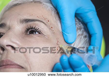 Platelet-rich plasma facial treatment. Close-up of mature woman receiving platelet-rich plasma injections for reducing wrinkles. View Large Photo Image Stock Image - Platelet-rich plasma facial treatment. Close-up of mature woman receiving platelet-rich plasma injections for reducing wrinkles.. Fotosearch