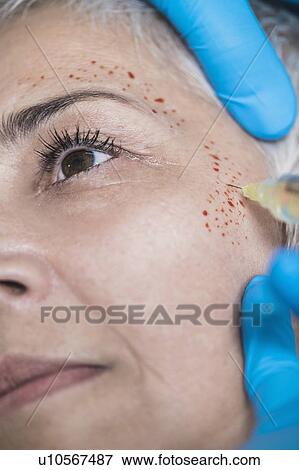 Platelet-rich plasma facial treatment. Close-up of mature woman receiving platelet-rich plasma injections for reducing wrinkles. View Large Photo Image Stock Photo - Platelet-rich plasma facial treatment. Close-up of mature woman receiving platelet-rich plasma injections for reducing wrinkles.. Fotosearch