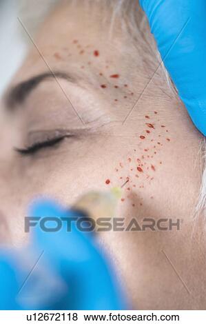 Stock Photo - Platelet-rich plasma facial treatment. Close-up of mature woman receiving platelet-rich plasma injections for reducing wrinkles.. Fotosearch