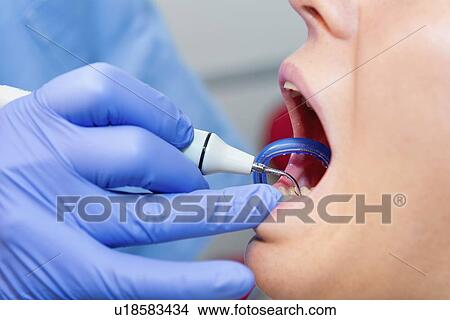 Removing dental tartar View Large Photo Image Picture - Removing dental tartar. Fotosearch