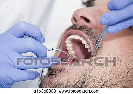Stock Image - Removing dental tartar. Fotosearch