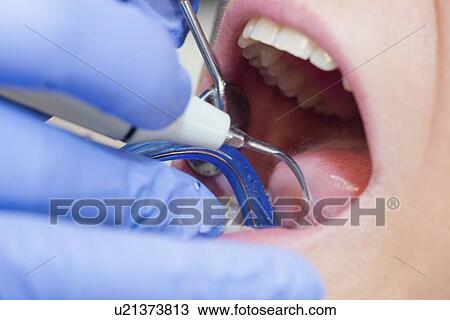 Removing dental tartar View Large Photo Image Stock Image - Removing dental tartar. Fotosearch