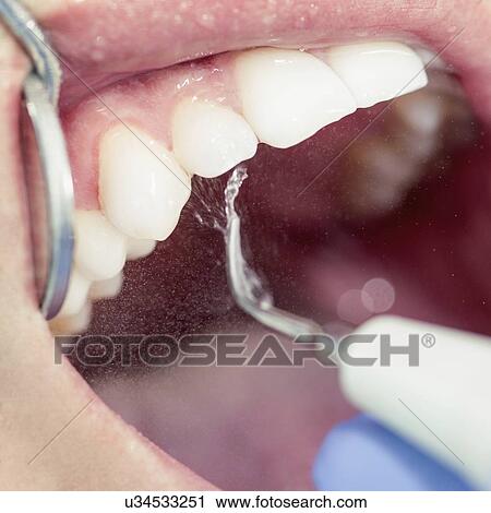 Removing dental tartar View Large Photo Image Stock Image - Removing dental tartar. Fotosearch