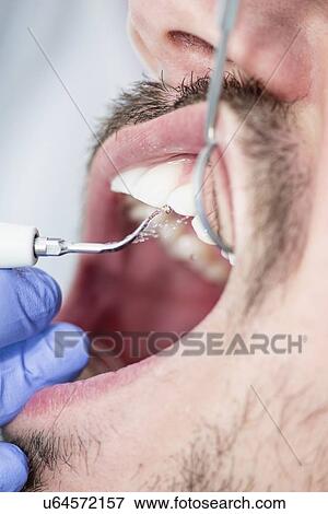 Removing dental tartar View Large Photo Image Stock Photo - Removing dental tartar. Fotosearch